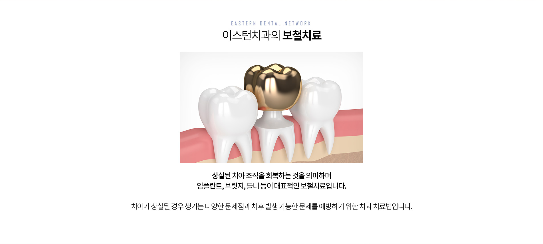 이스턴치과 보철치료